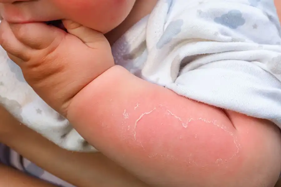 استفاده مناسب و اصولی از کرم ضد آفتاب، از آفتابسوختگی پوست حریری کودک پیشگیری میکند.