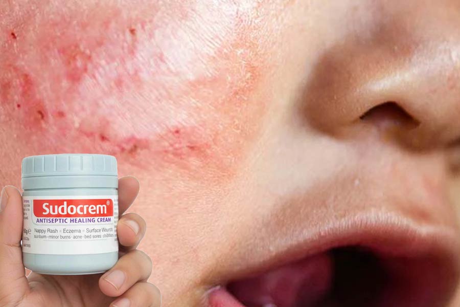 با استفاده روزانه از سودوکرم، پوست کودک شفافتر و نرمتر میشود.